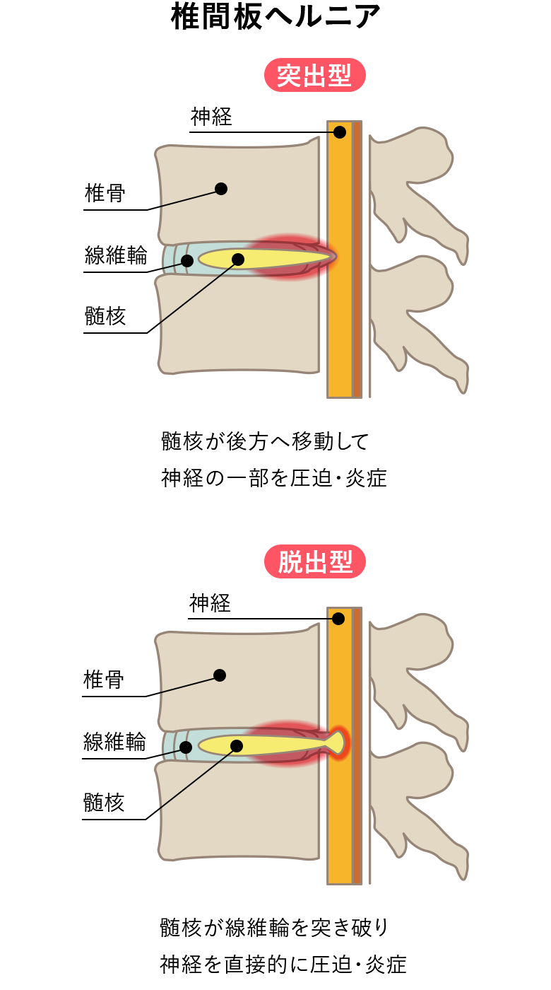 椎間板ヘルニア